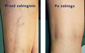 Przyczyny żylaków i pajączków